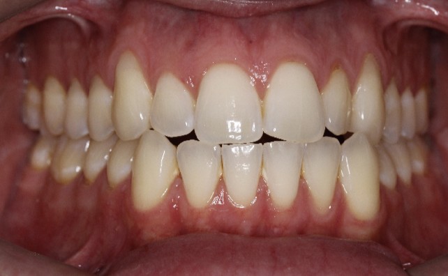 underbite-Case3 main- 1169_photo_initial_front underbite-Case3 main- 1169_photo_initial_front